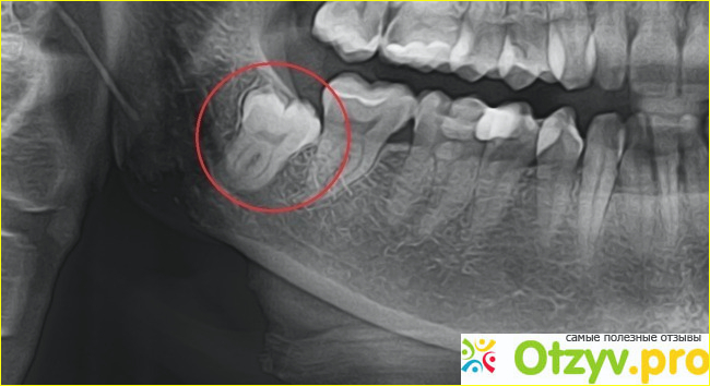 Отзыв о Удаление ретинированного зуба мудрости