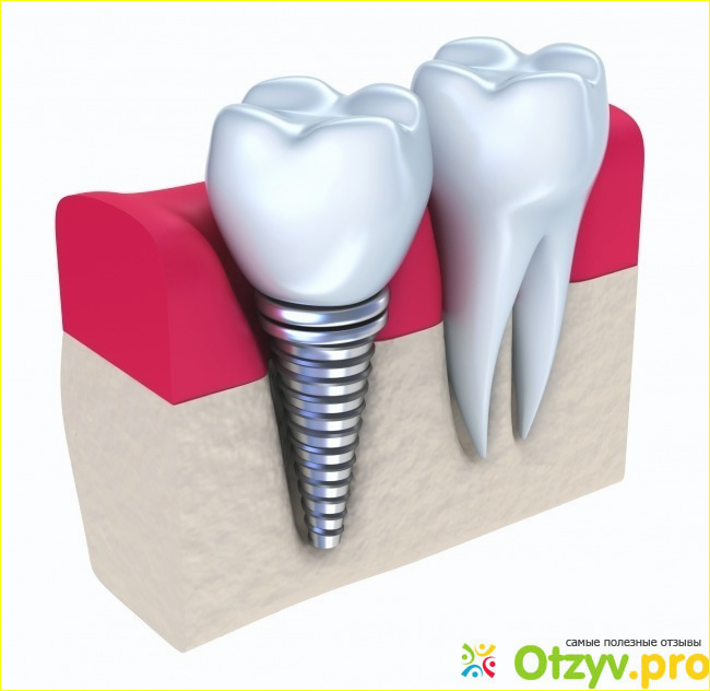 Отзыв о Имплантирование зубов