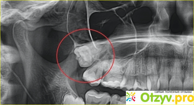 Удаление ретинированного зуба мудрости фото1