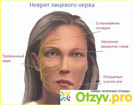 Отзыв о Неврит лицевого нерва