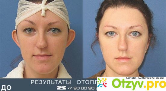 Уши до и после пластики фото