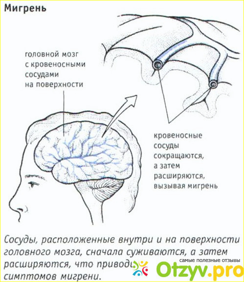 Как лечить мигрень