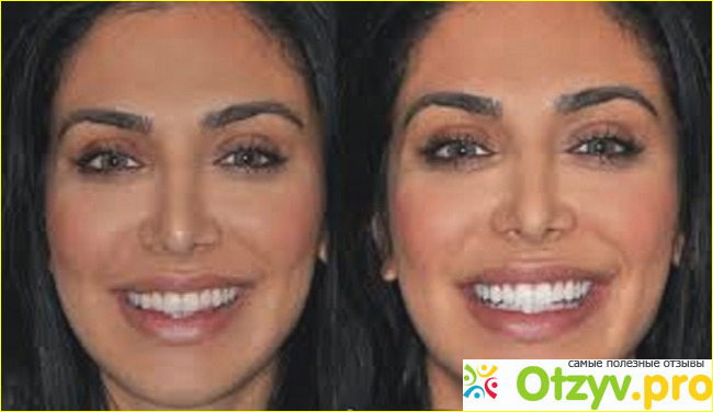 Tooth whitening фото2