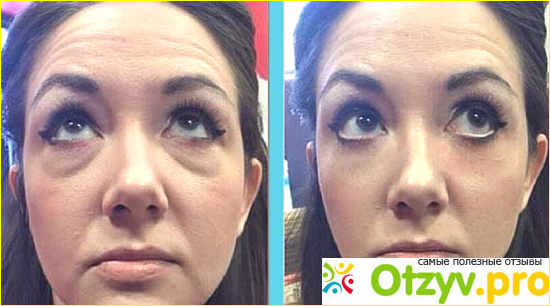 Отзыв о Instantly ageless отзывы