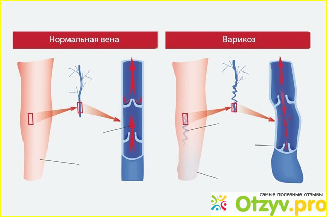 Варикоз фото1