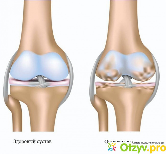 Артра для лечения остеоартроза 