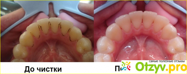 С помощью профессиональной чистки можно избавиться от налета и зубного камня