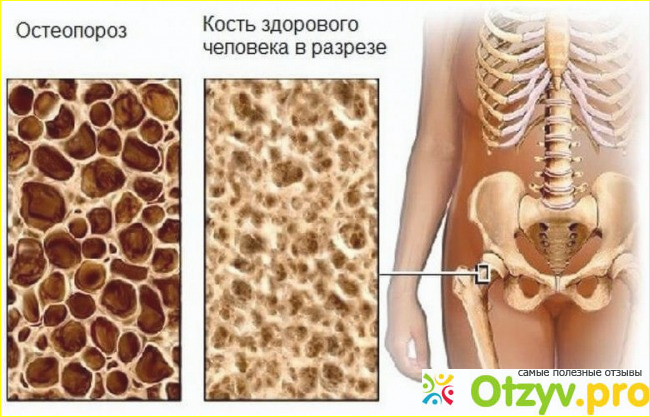 Симптомы остеопороза.