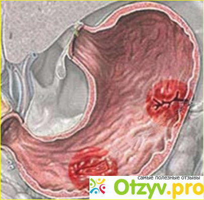 Лечение язвы желудки народным способом.