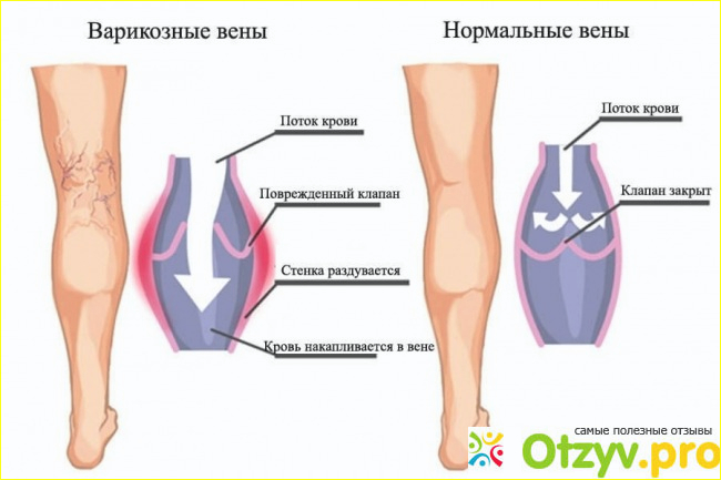 Что такое варикоз