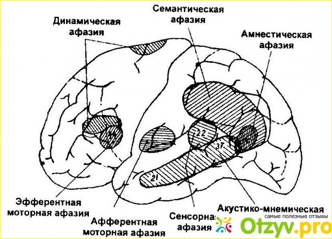 Виды афазии, диагностика