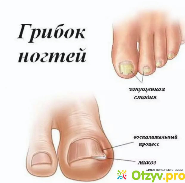 Как лечить ноготь от грибка 