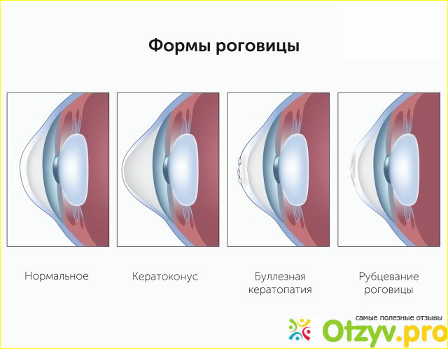 Отзыв о Буллезная кератопатия — Симптомы и лечение