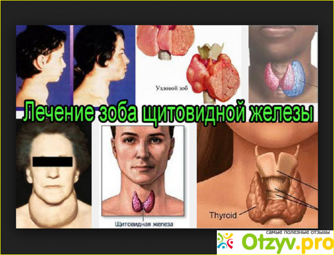 Лечение щитовидной железы в домашних условиях