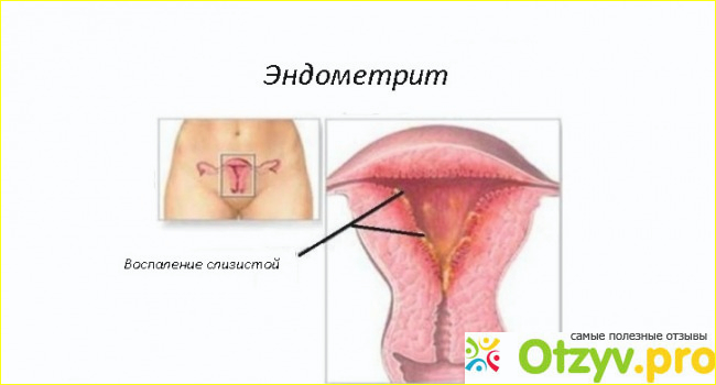 Как лечить эндометрит