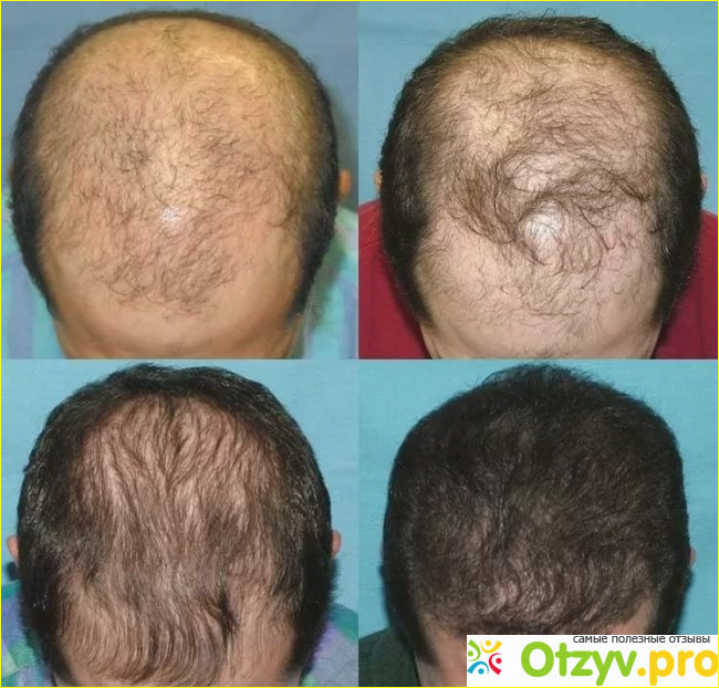 Отзыв о Minoxidil (Миноксидил)