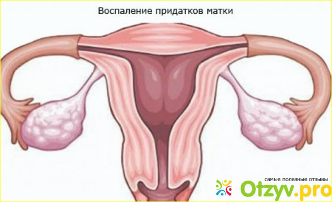 Отзыв о Воспаление придатков матки: симптомы и особенности