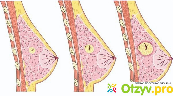 Мастопатия - причины