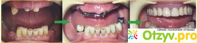 Имплантация зубов фото1