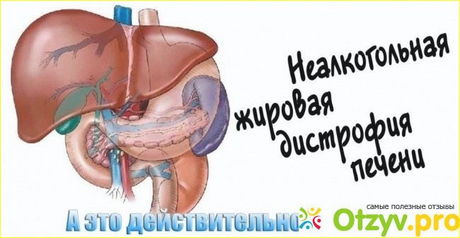 Неалкогольная жировая болезнь – это накопление