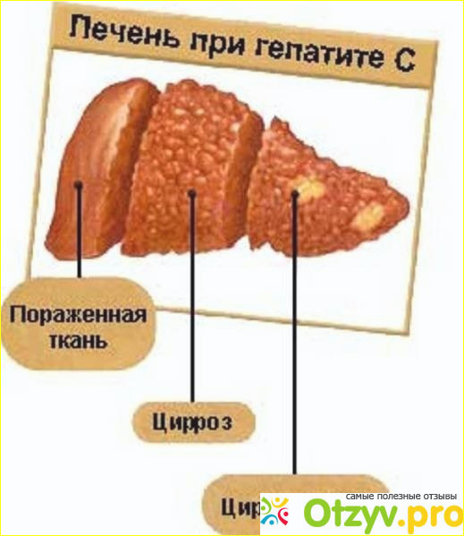 Даклатасвир и Софосбувир