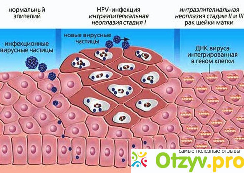 Отзыв о Вирус папилломы человека у женщин в гинекологии