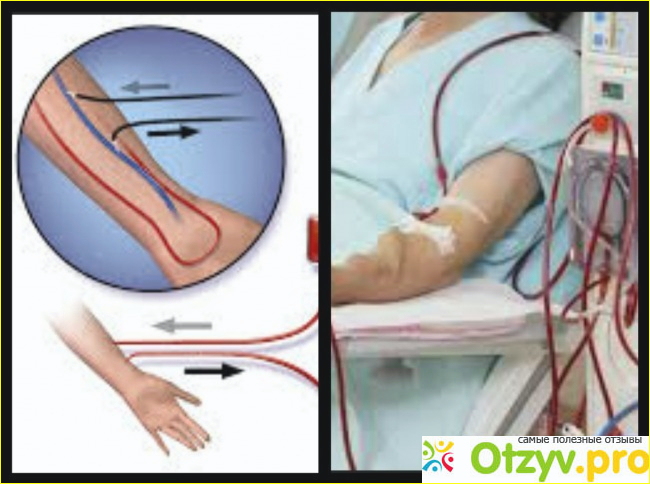 Отзыв о Процедура диализ