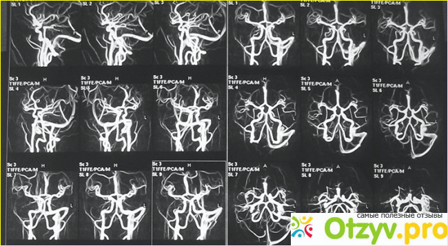Как проверить сосуды головного мозга и шеи фото1