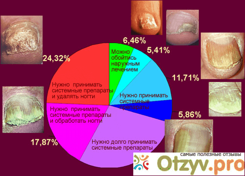 Какие симптомы того, что ноготь поразил грибок?