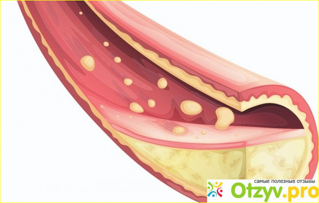 Aterol для снижения холестерина: обзор, цена, купить фото1