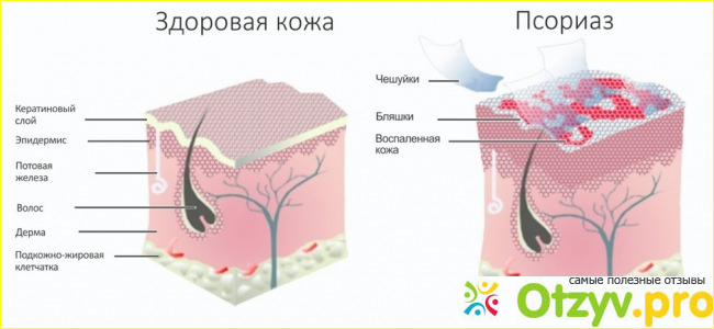 Как лечить псориаз, эффективные средства