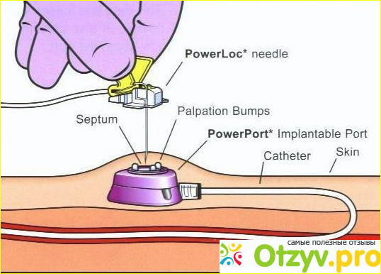 Преимущества имплантируемых порт -систем port-a Cath