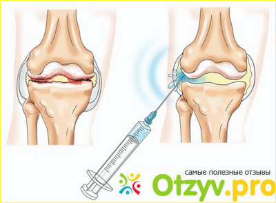 Отзыв о Плазмолифтинг суставов отзывы отрицательные