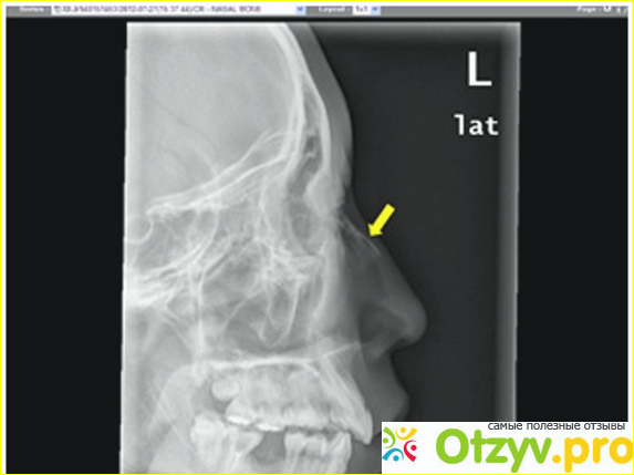 Коррекция носа прошла очень опасно для меня