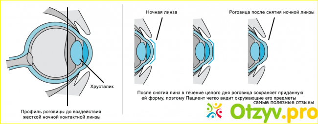 Отзыв о Ночные линзы для восстановления зрения отзывы врачей