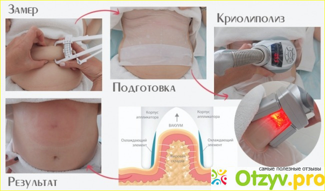 О проведении самой процедуры