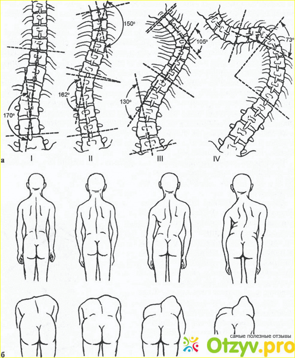 Где купить диск с методикой избавления от сколиоза