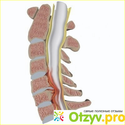Что такое миелопатия?