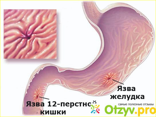 Схема лечения язвы 12 перстной кишки