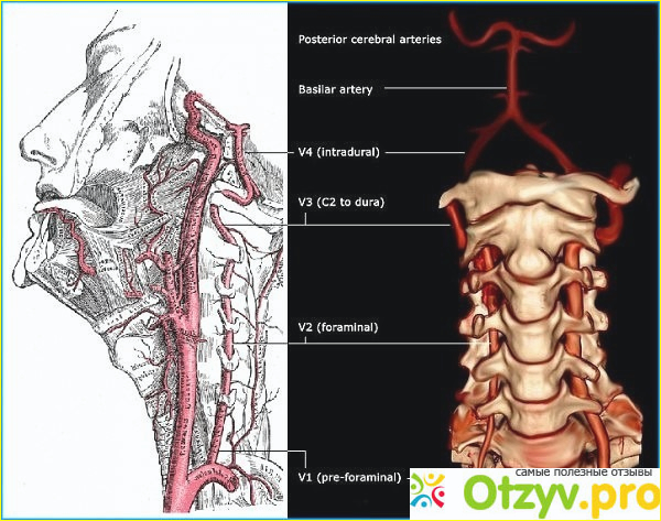 Особенности гипоплазии левой позвоночной артерии.