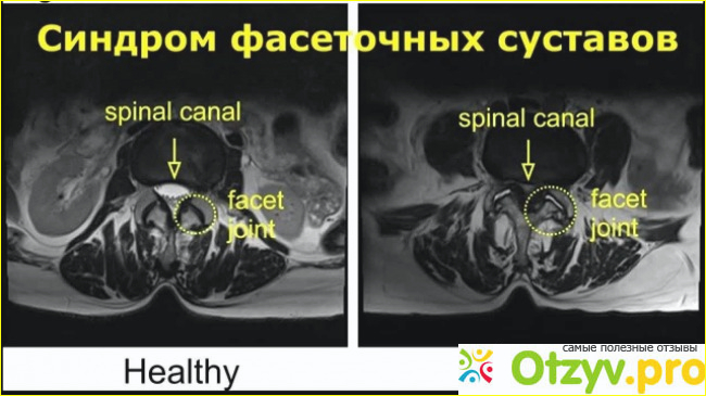 Отзыв о Фасеточный синдром