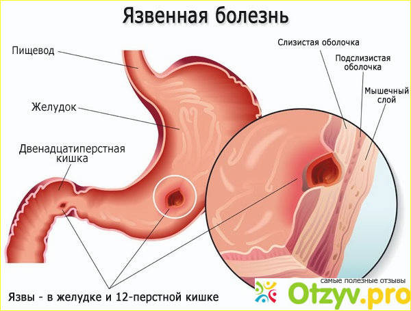 Язва луковицы двенадцатиперстной кишки.