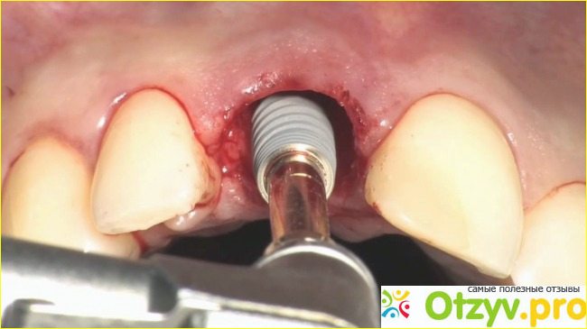 Одноэтапная имплантация зубов отзывы отрицательные фото1