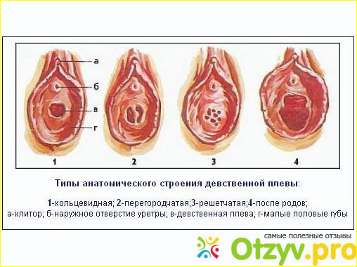 Виды девственной плевы