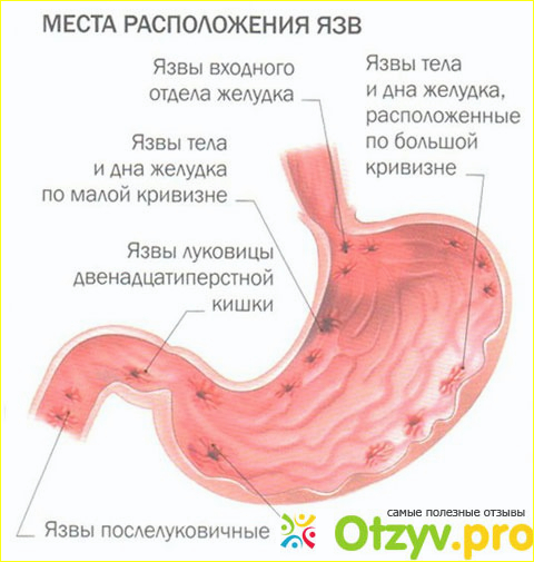 Язва двенадцатиперстной кишки