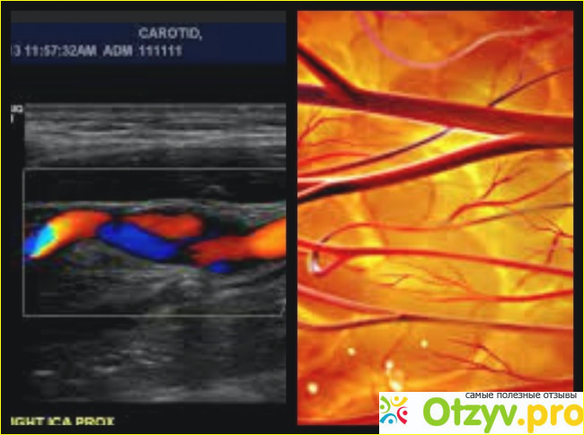 Отзыв о Узи брахиоцефальных сосудов
