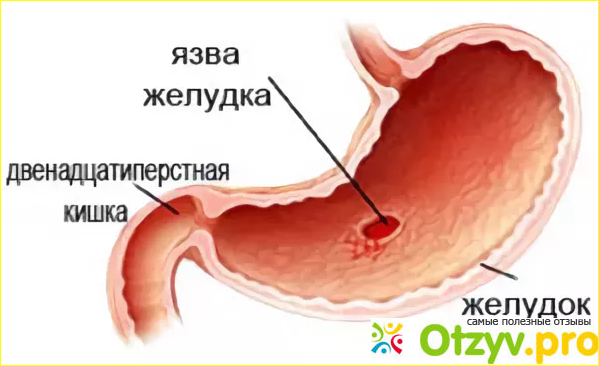 Препараты для лечения язвы желудка.