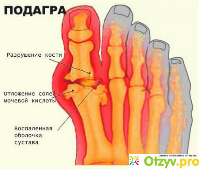 Отзыв о Мочевая кислота в организме человека чем опасна