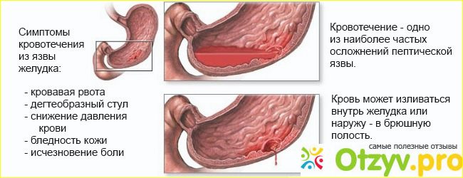 Симптомы язвенного кровотечения фото1
