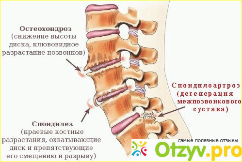 Фасеточный синдром фото1